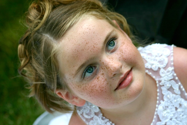 Freckles Galore