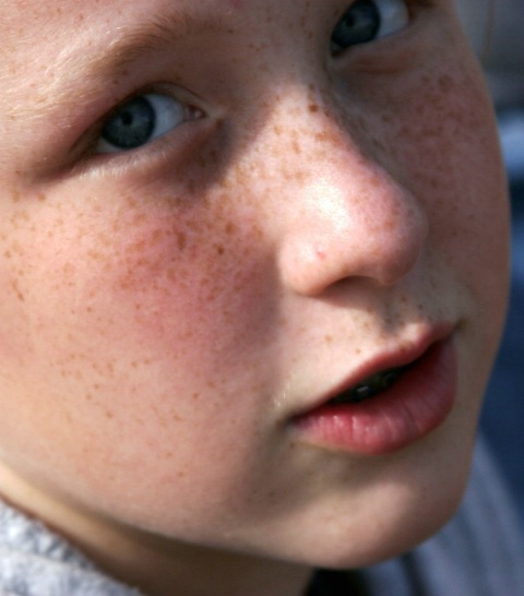 Freckles