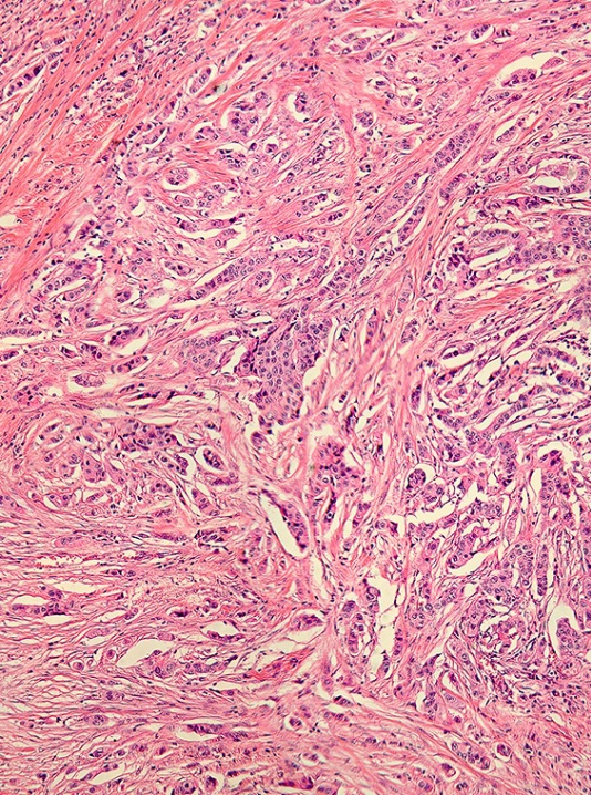 Breast Cancer (Histology Panorama) - ID: 5976863 © Carolina K. Smith