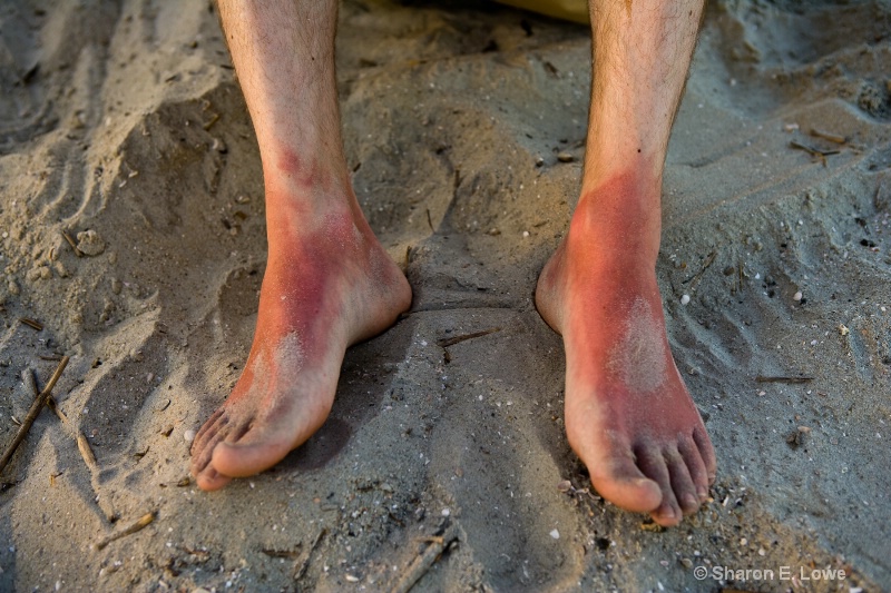 Charlie's incredibly sunburned feet - ouch!! - ID: 9083730 © Sharon E. Lowe