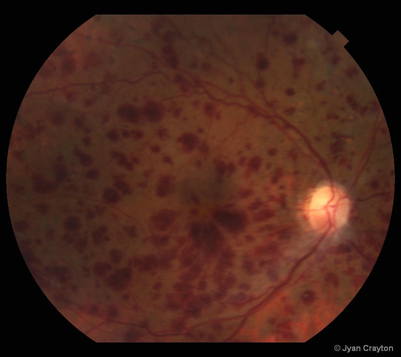 Central Retinal Vein Occlusion - color fundus - ID: 11279044 © Jyan L. Crayton